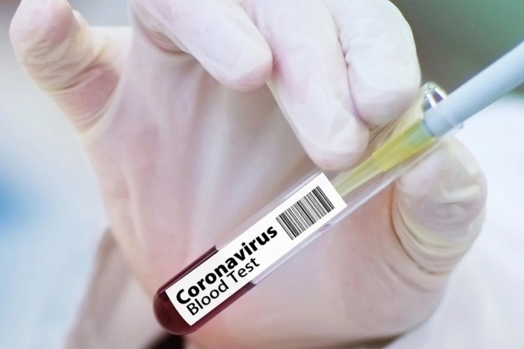 Najviše novozaraženih u Doboju, ukupno oboljelo 85 ljudi