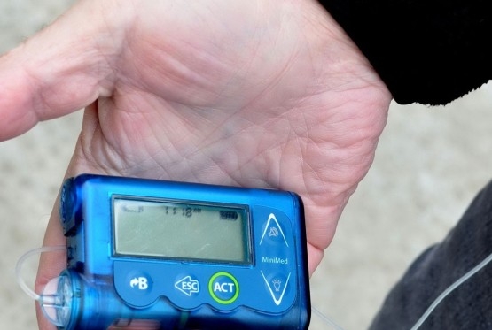 Raste broj mališana oboljelih od dijabetesa tip 1