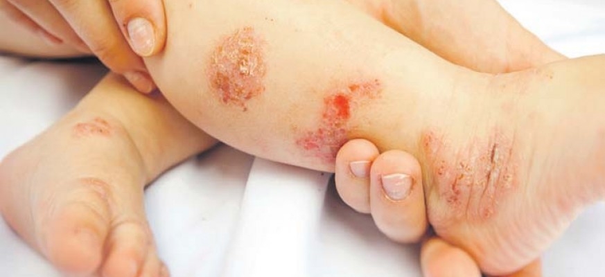 FZO RS: Od danas na listi fonda sredstva za oboljele od bulozne epidermolize