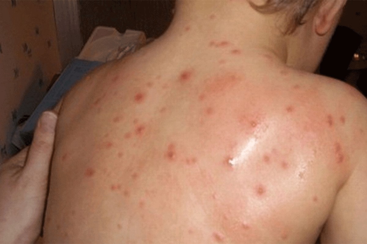 DOBOJ: Tri slučaja morbila kod nevakcinisane djece