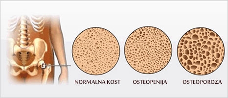 ZVEZDA PHARM: Besplatno mjerenje gustine kosti