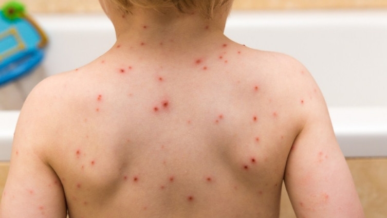 DOBOJSKI INFO DONOSI: Epidemiološka situacija morbila u Republici Srpskoj